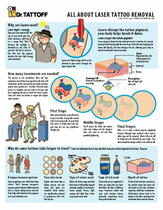 Tattoo Removal